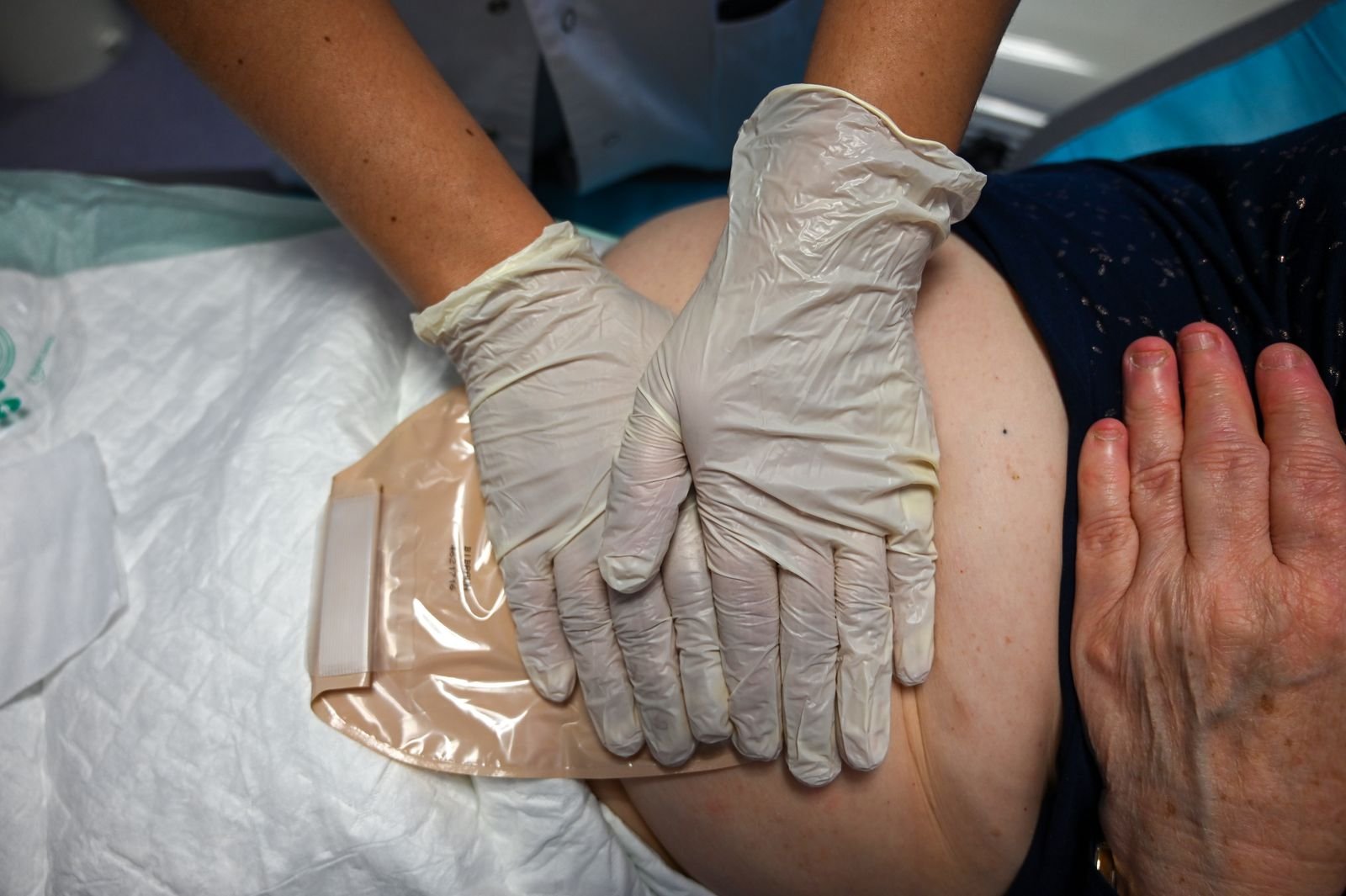 Profissional de saúde com luvas aplicando bolsa de colostomia no abdômen do paciente